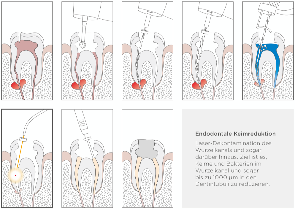 Endodontale Keimreduktion.PNG
